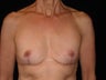 60 year old weight lifter wanted breast implant removal for recurrent capsular contracture.