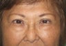 64 year old female who desired double lid surgery