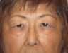 64 year old female who desired double lid surgery