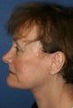 Face Lift