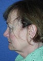 Face Lift