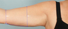 Smart Lipo: Upper Arm Area