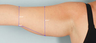 Smart Lipo: Upper Arm Area