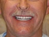 70 year old male treated with All-on-4 Dental Implant Procedure