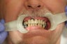 70 year old male treated with All-on-4 Dental Implant Procedure