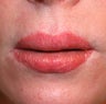 40 Year Old Female With Poor Lip Advancement Result