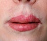40 Year Old Female With Poor Lip Advancement Result
