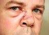 Mohs Surgery for Skin Cancer Removal