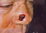 Mohs Surgery for Skin Cancer Removal