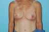 Stacked DIEP Flap Breast Reconstruction in Delayed/Immediate Setting