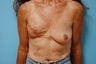 Stacked DIEP Flap Breast Reconstruction in Delayed/Immediate Setting