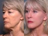 Facelift