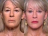 Facelift