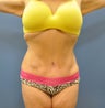 Hourglass Tummy Tuck by Dr. Wilberto Cortes