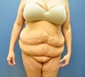 Hourglass Tummy Tuck by Dr. Wilberto Cortes