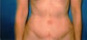 55 Year Old Female Abdominoplasty