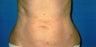 55 Year Old Female Abdominoplasty