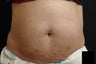 Coolsculpting
