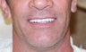 40 year old Male treated with All-on-4 Dental Implant Procedure