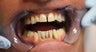 40 year old Male treated with All-on-4 Dental Implant Procedure