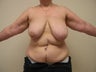 Breast Reconstruction after mastectomy