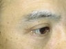 Upper Eyelid Blepharoplasty