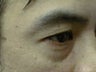Upper Eyelid Blepharoplasty