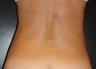 SmartLipo MPX