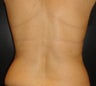 SmartLipo MPX