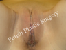 Labial Reduction