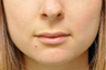 Subtle Lip Augmentation using Microcannula