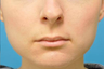 Subtle Lip Augmentation using Microcannula