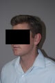 26 y/o man with fat underneath chin and neck treated with VASER (ultrasound assisted liposuction)