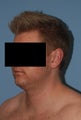 26 y/o man with fat underneath chin and neck treated with VASER (ultrasound assisted liposuction)