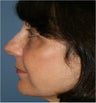 53 year old female with facial volume loss, puffiness around her eyes, and loss of jaw line support requesting fat injections