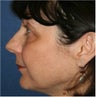 53 year old female with facial volume loss, puffiness around her eyes, and loss of jaw line support requesting fat injections