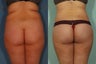 Buttock Lift