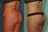 Buttock Lift