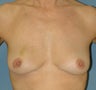 Breast Reconstruction