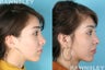 Rhinoplasty