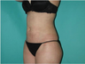 Liposuction 6 Months Post Operative
