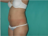 Liposuction 6 Months Post Operative