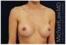 Breast Augmentation