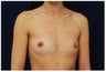 Breast Augmentation