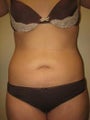 Smart Lipo