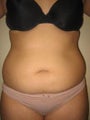 Smart Lipo