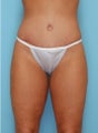 26 year old woman who lost 60 lbs through diet and exercise who underwent body lift