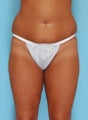 26 year old woman who lost 60 lbs through diet and exercise who underwent body lift