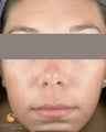 Female treated with 4 Photodynamic Therapy with Levulan for acne