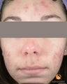 Female treated with 4 Photodynamic Therapy with Levulan for acne